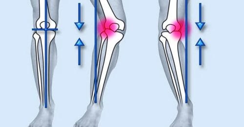 Chân vòng kiềng là gì?
