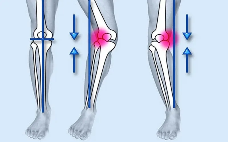Chân vòng kiềng là gì? Nguyên nhân và cách điều trị tac hai cua chan vong kieng 2 Tác hại của chân vòng kiềng
